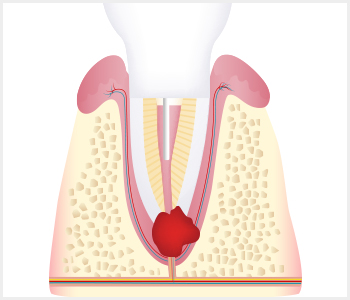 뿌리 끝에 염증이 있는 치아를 발치하기 전 단면 일러스트